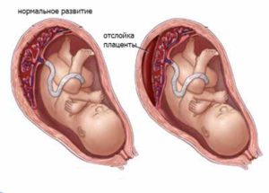 13 недель отслойка плаценты