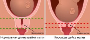 Шейка мягкая при беременности