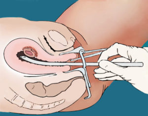 Можно ли забеременеть после выскабливания