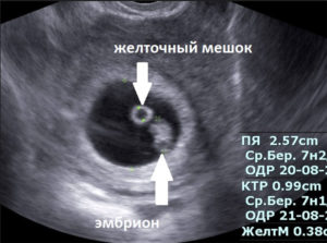 На узи не видно эмбриона срок 5 недель