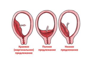 Предлежание плаценты 20 недель