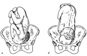 Предлежание головка это как