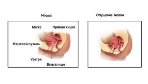 Опущение матки при беременности