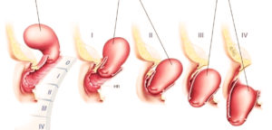 Опущение матки при беременности
