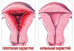При климаксе разрастание эндометрия