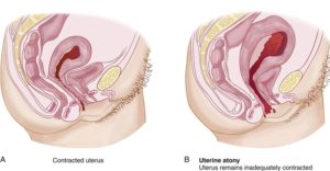 Если матка плохо сокращается после родов что делать