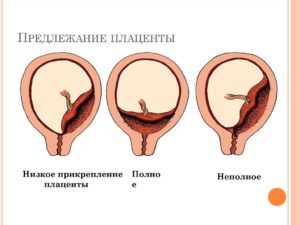 Предлежание плаценты 30 недель