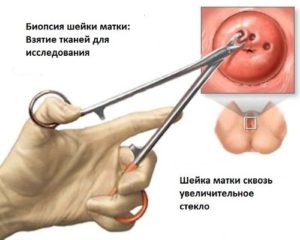 Можно ли делать биопсию шейки матки при беременности