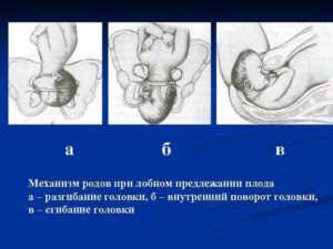 При лобном предлежании доношенного плода родоразрешение проводят