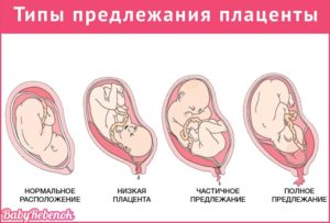 Когда поднимается плацента при беременности