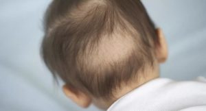 Волосы выпадают у месячного ребенка
