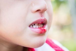 Что делать если губу разбили