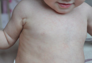 Сыпь у ребенка после температуры розеола