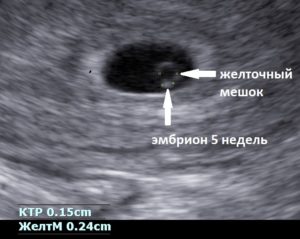 На каком сроке визуализируется эмбрион в плодном яйце