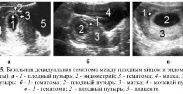 Отслойка плодного яйца на ранних сроках беременности форум