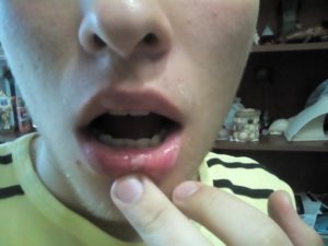 Что делать если губу разбили