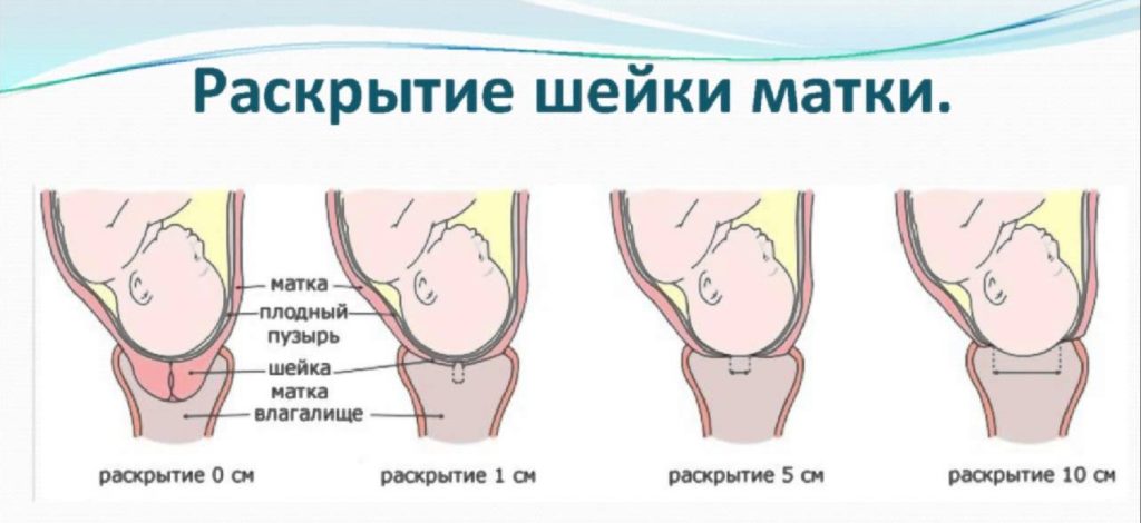 Физические упражнения для раскрытия шейки матки перед родами