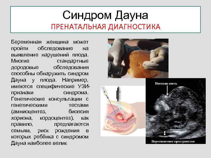 Синдром дауна при беременности диагностика