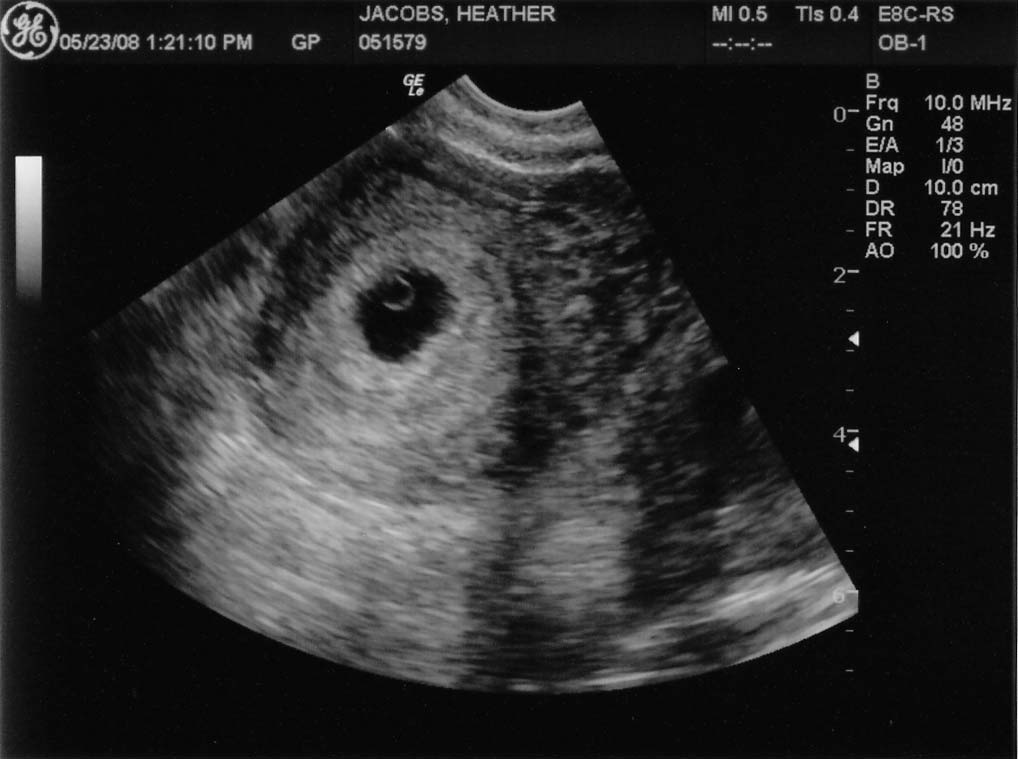 Неделя после зачатия узи. УЗИ плода 4 недели беременности. Фото УЗИ беременности 4 недели. 4.4 Недели беременности УЗИ. Эмбрион на 4 неделе беременности УЗИ.