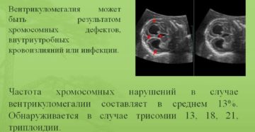 Вентрикуломегалия лечение у плода