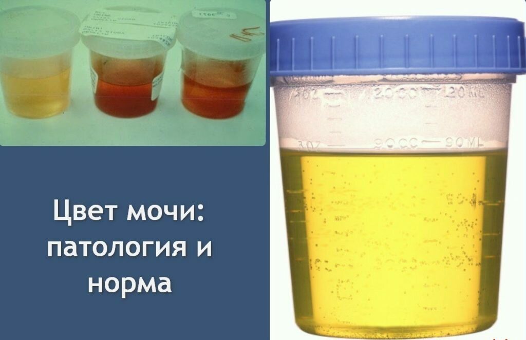 При беременности пахнет моча