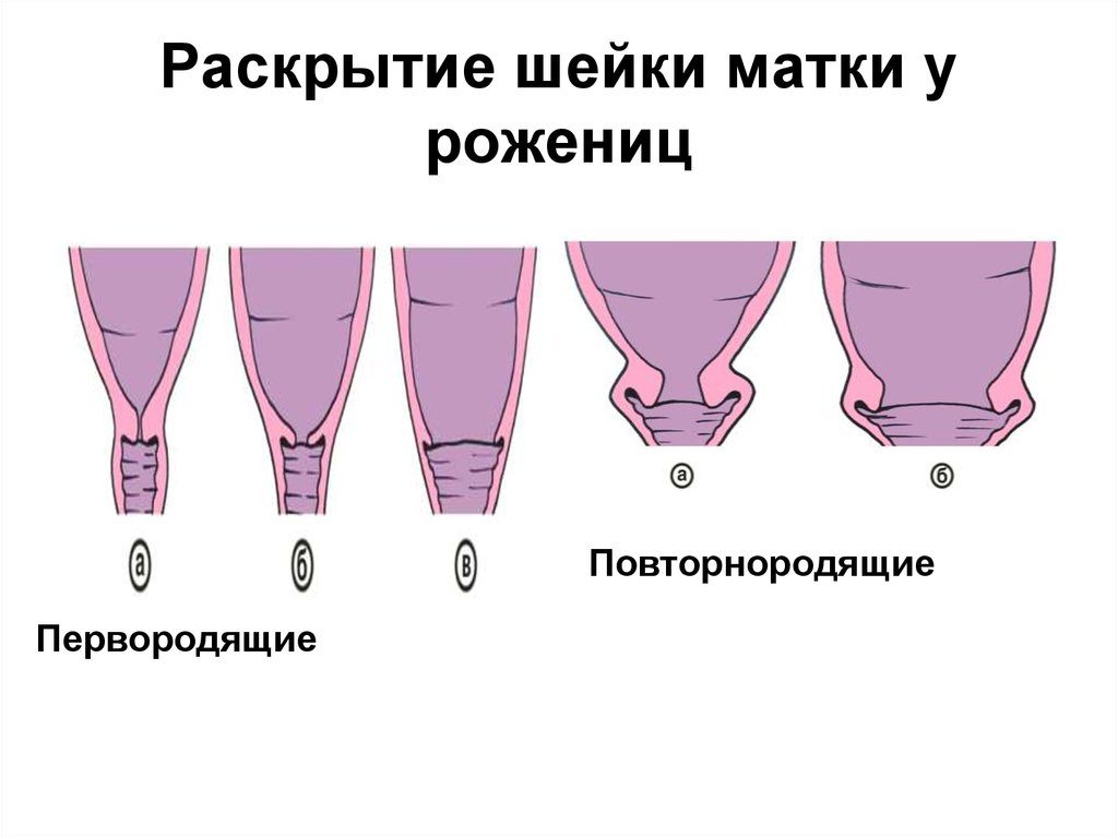 Как выглядит раскрытие шейки матки на 2 пальца