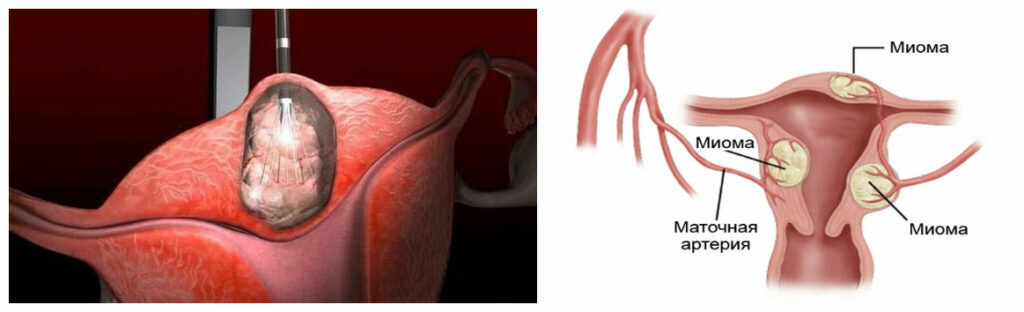 Миома рассосалась во время климакса миф или реальность
