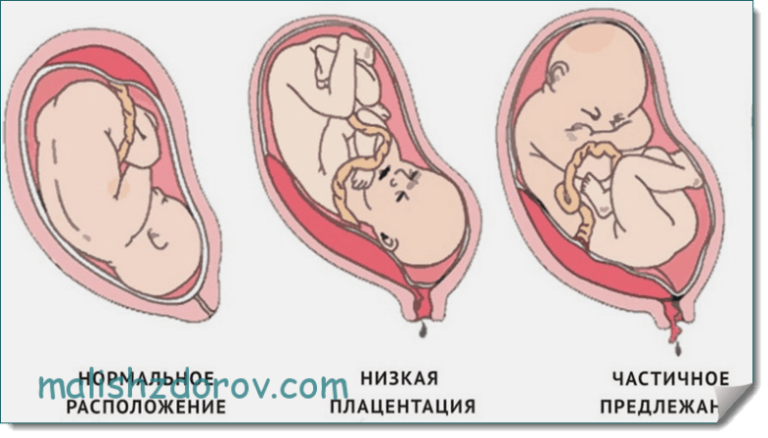 Плацента по передней стенке низко. Краевое предлежание хориона 12. Предлежание плаценты на 12 неделе беременности. Краевое прикрепление хориона 12 недель.