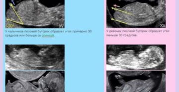 На какой неделе беременности узи показывает пол ребенка