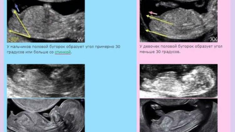 На какой неделе беременности узи показывает пол ребенка