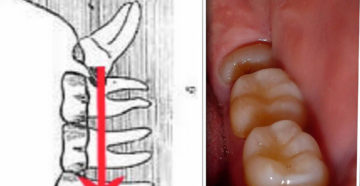 Зуб мудрости не может прорезаться