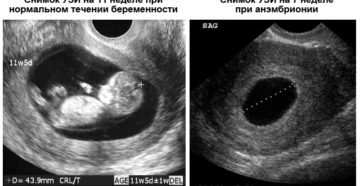 На какой неделе на узи видно сердцебиение плода