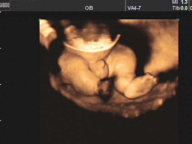 Пол ребенка 17 недель беременности фото