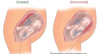 Плацента расположена по передней стенке матки высоко