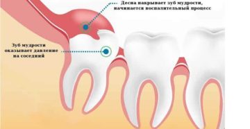 Зуб мудрости воспалился при беременности