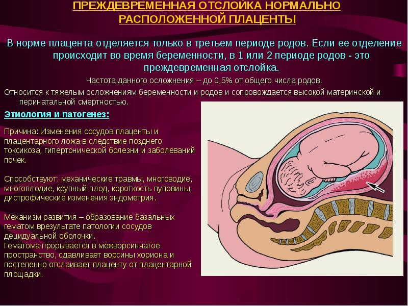 Отделение плаценты при беременности