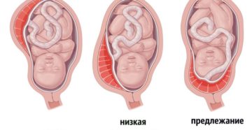 Когда поднимается плацента при беременности