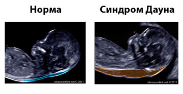 Можно ли выявить дцп при беременности на узи