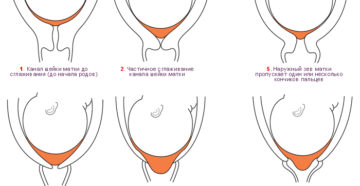 Что значит длинная шейка матки при беременности