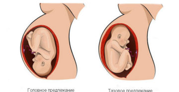 Головное предлежание плода при беременности на 20 неделе