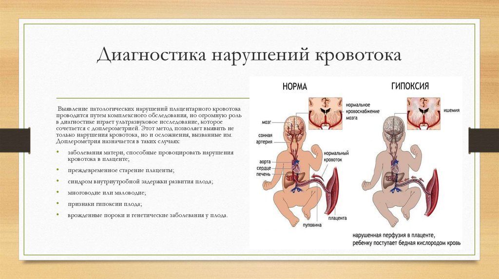 Нарушение кровотока при беременности 1а