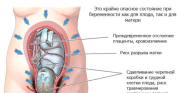 Тонус матки на 32 неделе беременности симптомы