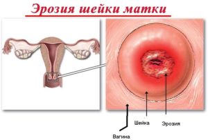 Эрозия матки во время беременности