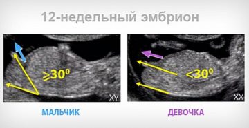 На первом узи можно ли узнать пол ребенка