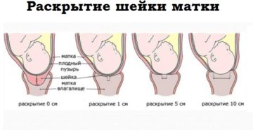 Почему шейка матки не раскрывается во время родов