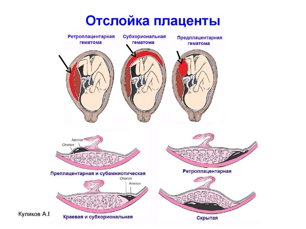 Отслойка плаценты на ранних сроках беременности лечение форум