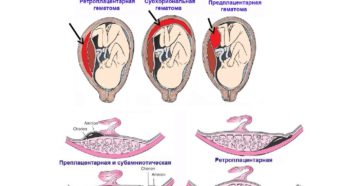 Отслойка плаценты на ранних сроках беременности лечение форум