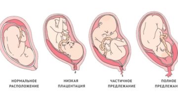 Низкое прикрепление плаценты по передней стенке матки