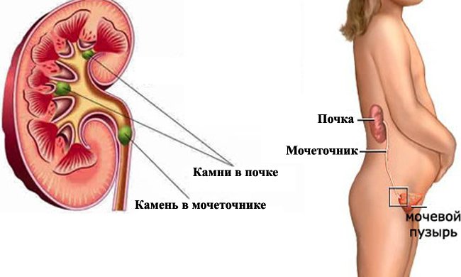 Камни в почках симптомы у женщин при беременности