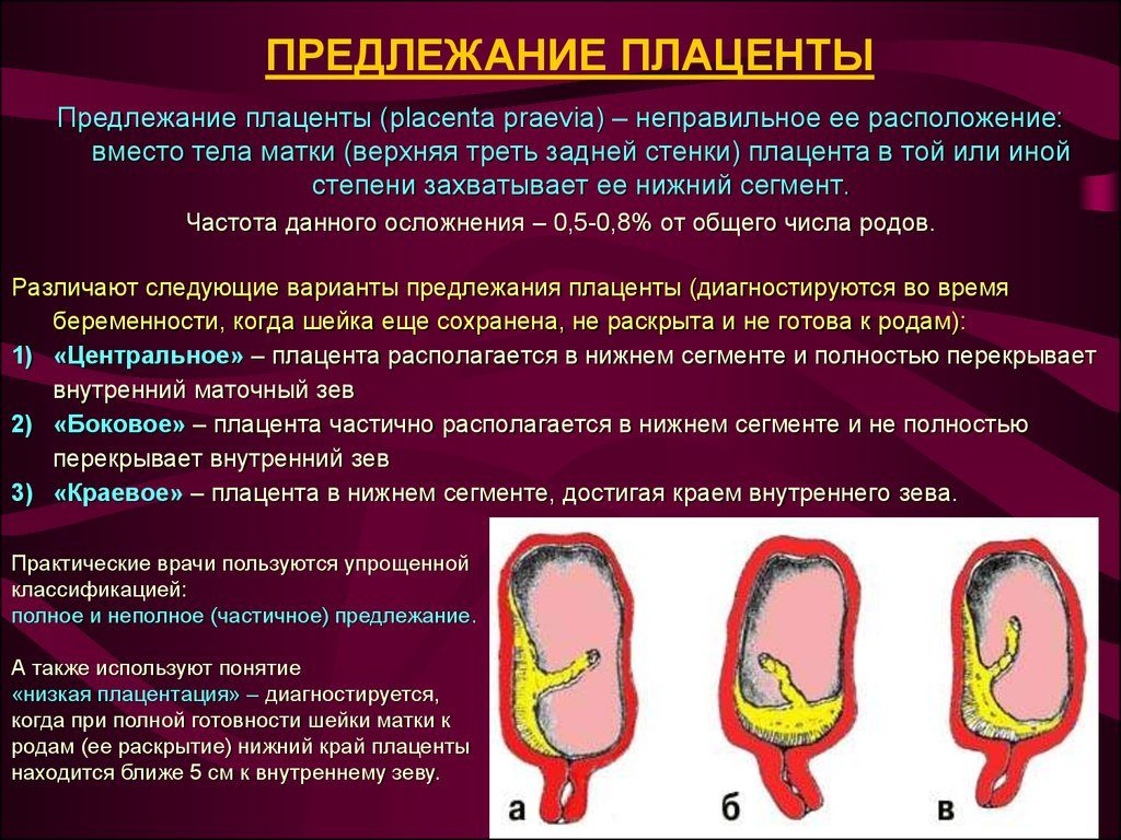 Плацента по задней стенке перекрывает внутренний зев